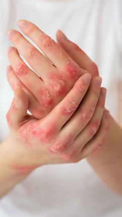 Eating Eggs May Be Harmful for These 5 People