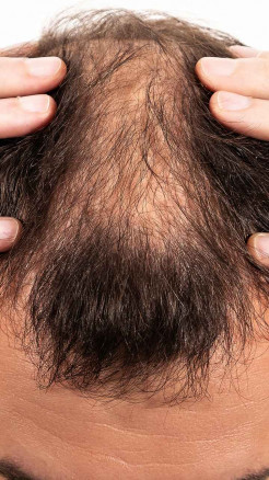 Does Hair Fall Increase in Winter? – 6 Truths