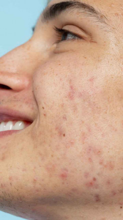 चेहरे पर बार-बार पिंपल क्यों होते हैं? जानिए 6 बड़े कारण